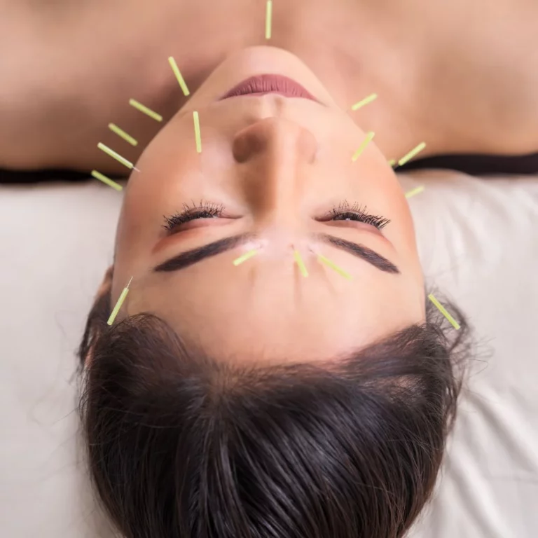 Cosmetic Acupuncture