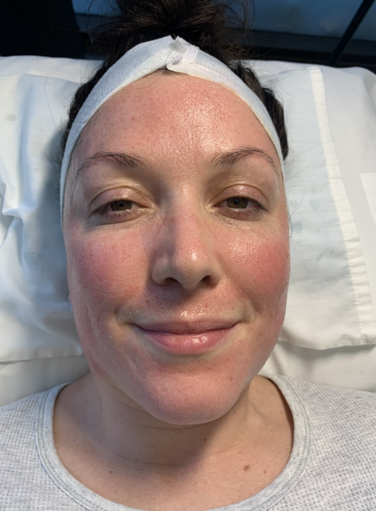 Why Micro Needling Is So Important to Your Skin’s Health