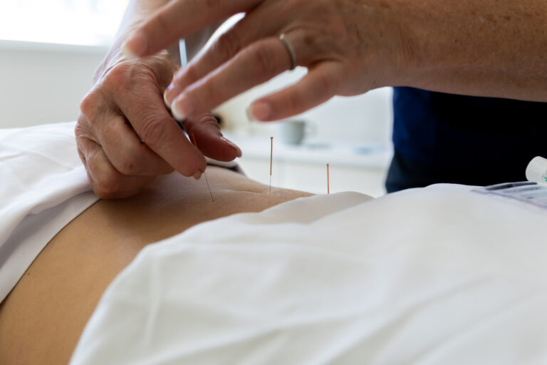 Acupuncture for pain